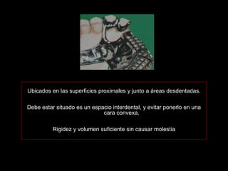 Ubicados en las superficies proximales y junto a áreas desdentadas.

Debe estar situado es un espacio interdental, y evitar ponerlo en una
                             cara convexa.

          Rigidez y volumen suficiente sin causar molestia
 