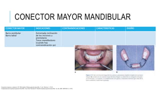 CONECTOR MAYOR MANDIBULAR
CONECTOR MAYOR INDICACIONES CONTRAINDICACIONES CARACTERISTICAS DISEÑO
Barra vestibular
Barra labial
Extremada inclinación
de los incisivos y
premolares
Torus mandibulares
(cuando hay
contraindicación qx)
Conectores mayores y menores. EN: McCracken, Prótesis parcial removible, 11 ed., Elsevier, 5, 35-65.
Componentes de la prótesis parcial removible. Loza D & Valverde H. Diseño de prótesis parcial removible. 1ra. Ed. 2007. RIPANO, 2, 16-92
 