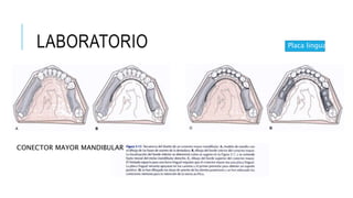 Placa lingual
CONECTOR MAYOR MANDIBULAR
LABORATORIO
 