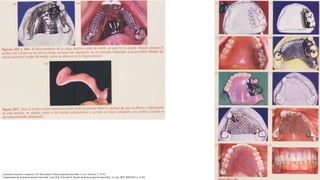 Conectores mayores y menores. EN: McCracken, Prótesis parcial removible, 11 ed., Elsevier, 5, 35-65.
Componentes de la prótesis parcial removible. Loza D & Valverde H. Diseño de prótesis parcial removible. 1ra. Ed. 2007. RIPANO, 2, 16-92
 