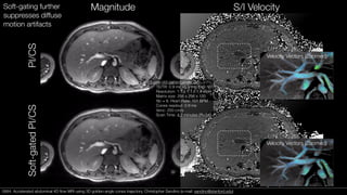 Velocity Vectors (Zoomed)
3-year-old patient under GA:
TE/TR: 0.9 ms / 3.6 ms; Flip: 15°
Resolution: 1.1 x 1.1 x 1.4 mm3
Matrix size: 256 x 256 x 120
Nc = 8, Heart Rate: 101 BPM
Cones readout: 0.9 ms
Venc: 250 cm/s
Scan Time: 4.2 minutes (R=34)
Magnitude S/I Velocity
PI/CSSoft-gatedPI/CS
Soft-gating further
suppresses diffuse
motion artifacts
Velocity Vectors (Zoomed)
0684. Accelerated abdominal 4D ﬂow MRI using 3D golden-angle cones trajectory. Christopher Sandino (e-mail: sandino@stanford.edu)0684. Accelerated abdominal 4D ﬂow MRI using 3D golden-angle cones trajectory. Christopher Sandino (e-mail: sandino@stanford.edu)
 