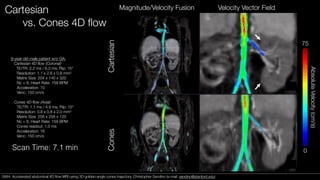 Cartesian
vs. Cones 4D ﬂow
9-year-old male patient w/o GA:
Cartesian 4D flow (Coronal)
TE/TR: 2.2 ms / 6.3 ms; Flip: 15°
Resolution: 1.1 x 2.6 x 0.8 mm3
Matrix Size: 204 x 140 x 320
Nc = 8, Heart Rate: 159 BPM
Acceleration: 10
Venc: 150 cm/s
Cones 4D flow (Axial)
TE/TR: 1.1 ms / 4.9 ms; Flip: 15°
Resolution: 0.8 x 0.8 x 2.0 mm3
Matrix Size: 256 x 256 x 120
Nc = 8, Heart Rate: 159 BPM
Cones readout: 1.0 ms
Acceleration: 16
Venc: 150 cm/s
Scan Time: 7.1 min
Magnitude/Velocity Fusion Velocity Vector Field
CartesianCones
AbsoluteVelocity(cm/s)
75
0
0684. Accelerated abdominal 4D ﬂow MRI using 3D golden-angle cones trajectory. Christopher Sandino (e-mail: sandino@stanford.edu)0684. Accelerated abdominal 4D ﬂow MRI using 3D golden-angle cones trajectory. Christopher Sandino (e-mail: sandino@stanford.edu)
 