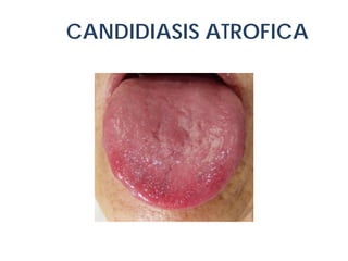 CANDIDIASIS ATROFICA

 