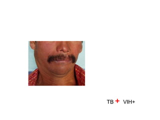 TB + VIH+

 
