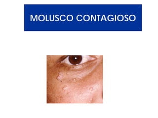MOLUSCO CONTAGIOSO

 