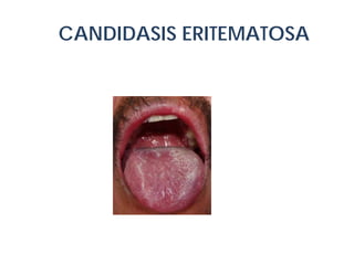 CANDIDASIS ERITEMATOSA

OK 74M

 