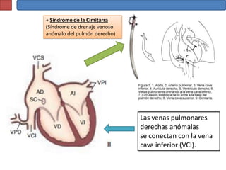 + Síndrome de la Cimitarra
(Síndrome de drenaje venoso
anómalo del pulmón derecho)




                              Las venas pulmonares
                              derechas anómalas
                              se conectan con la vena
                              cava inferior (VCI).
 