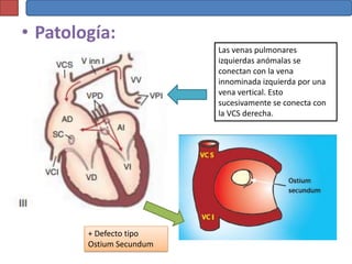 • Patología:
                          Las venas pulmonares
                          izquierdas anómalas se
                          conectan con la vena
                          innominada izquierda por una
                          vena vertical. Esto
                          sucesivamente se conecta con
                          la VCS derecha.




        + Defecto tipo
        Ostium Secundum
 