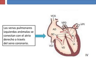 Las venas pulmonares
izquierdas anómalas se
conectan con el atrio
derecho a través
del seno coronario.
 