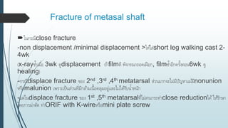 Fracture of metasal shaft
ในกรณีclose fracture
-non displacement /minimal displacement >ให้ใส่short leg walking cast 2-
4wk
(x-rayซ้าเมื่อ 3wk ดูdisplacement ถ้าfilmดี พิจารณาถอดเฝือก, filmซ้าอีกครั้งตอน6wk ดู
healing)
-กรณีdisplace fracture ของ 2nd ,3rd ,4th metatarsal ส่วนมากจะไม่มีปัญหาแม้มีnonunion
หรือmalunion เพราะเป็นส่วนที่มีกล้ามเนื้อคลุมอยู่และไม่ได้รับน้าหนัก
-แต่ในdisplace fracture ของ 1st ,5th metatarsalที่ไม่สามารถทาclose reductionได้ให้รักษา
โดยการผ่าตัด ทาORIF with K-wireหรือmini plate screw
 
