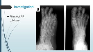 Investigation
Film foot AP
,oblique
 