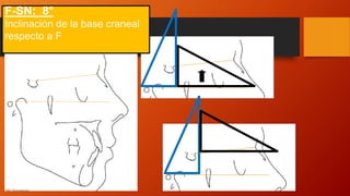 F-SN: 8°
Inclinación de la base craneal
respecto a F
 