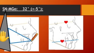 SN-MGo: 32° (+-5°):
 