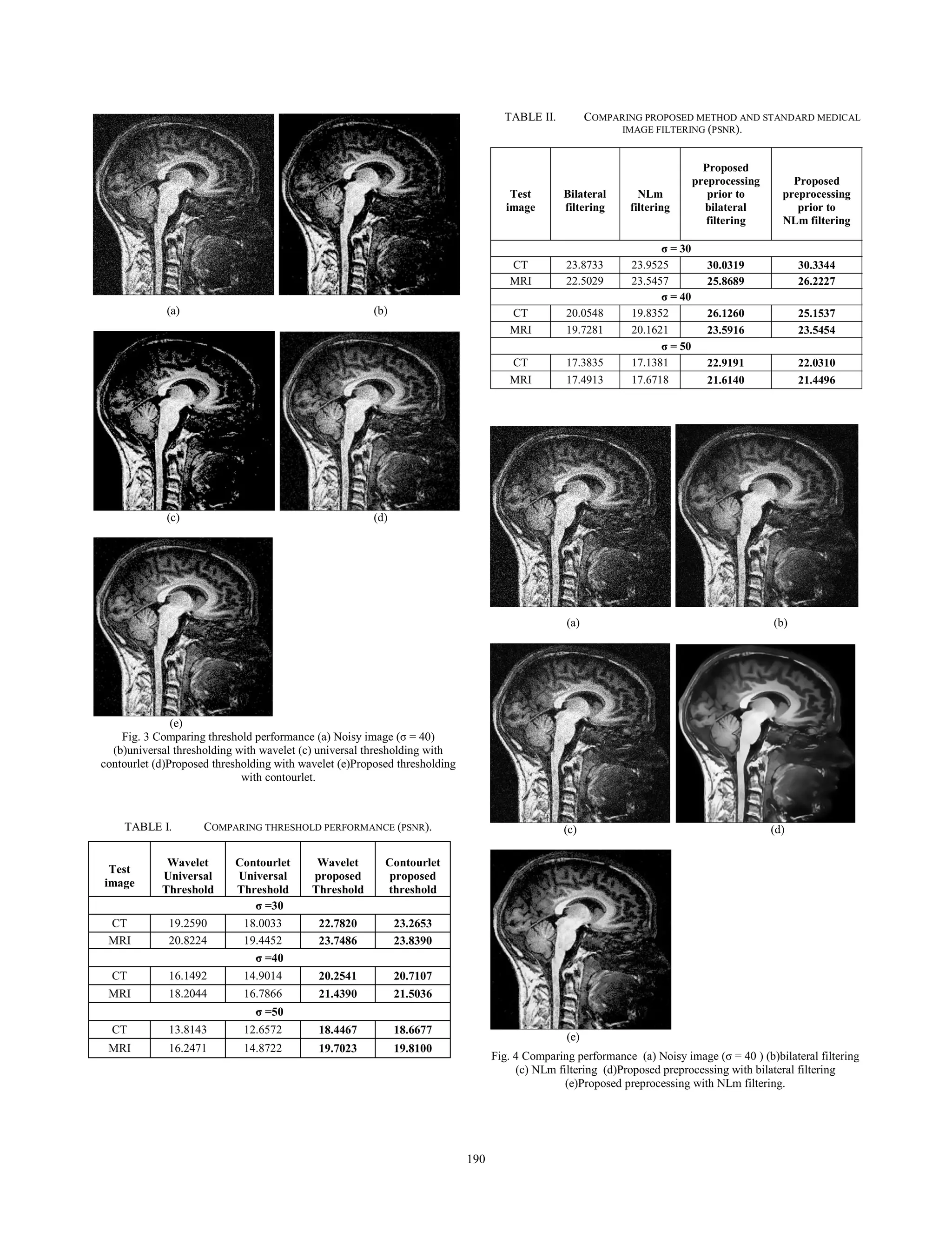 (a) (b)
(c) (d)
(e)
Fig. 3 Comparing threshold performance (a) Noisy image (ı = 40)
(b)universal thresholding with wavelet (c) universal thresholding with
contourlet (d)Proposed thresholding with wavelet (e)Proposed thresholding
with contourlet.
TABLE I. COMPARING THRESHOLD PERFORMANCE (PSNR).
TABLE II. COMPARING PROPOSED METHOD AND STANDARD MEDICAL
IMAGE FILTERING (PSNR).
(a) (b)
(c) (d)
(e)
Fig. 4 Comparing performance (a) Noisy image (ı = 40 ) (b)bilateral filtering
(c) NLm filtering (d)Proposed preprocessing with bilateral filtering
(e)Proposed preprocessing with NLm filtering.
Test
image
Wavelet
Universal
Threshold
Contourlet
Universal
Threshold
Wavelet
proposed
Threshold
Contourlet
proposed
threshold
ı =30
CT 19.2590 18.0033 22.7820 23.2653
MRI 20.8224 19.4452 23.7486 23.8390
ı =40
CT 16.1492 14.9014 20.2541 20.7107
MRI 18.2044 16.7866 21.4390 21.5036
ı =50
CT 13.8143 12.6572 18.4467 18.6677
MRI 16.2471 14.8722 19.7023 19.8100
Test
image
Bilateral
filtering
NLm
filtering
Proposed
preprocessing
prior to
bilateral
filtering
Proposed
preprocessing
prior to
NLm filtering
ı = 30
CT 23.8733 23.9525 30.0319 30.3344
MRI 22.5029 23.5457 25.8689 26.2227
ı = 40
CT 20.0548 19.8352 26.1260 25.1537
MRI 19.7281 20.1621 23.5916 23.5454
ı = 50
CT 17.3835 17.1381 22.9191 22.0310
MRI 17.4913 17.6718 21.6140 21.4496
190190
 