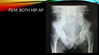 FILM: BOTH HIP AP
 