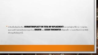 • ผ่าตัดเปลี่ยนข้อสะโพกเทียม (HEMIARTHROPLASTY OR TOTAL HIP REPLACEMENT) เหมาะสมในผู้ปวย ที่มีภาวะ ่่ กระดูกพรุน
รุนแรง และมีการแตกละเอียดของกระดูกบริเวณ GREATER และ LESSER TROCHANTER หรือผู้ปวยที่มี ่่ ภาวะแทรกซ้อนจากการผ่าตัดยึด
ตรึงกระดูกด้วยโลหะเท่านั้น
 