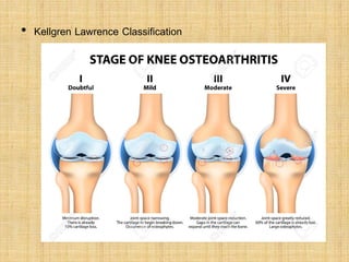 • Kellgren Lawrence Classification
 
