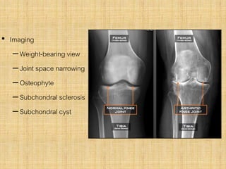 • Imaging
–Weight-bearing view
–Joint space narrowing
–Osteophyte
–Subchondral sclerosis
–Subchondral cyst
 