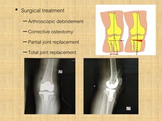 • Surgical treatment
–Arthroscopic debridement
–Corrective osteotomy
–Partial joint replacement
–Total joint replacement
 