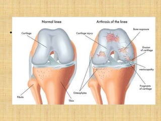 • Anatomy of synovial joint
 