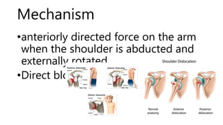 Mechanism
•anteriorly directed force on the arm
when the shoulder is abducted and
externally rotated
•Direct blow
 