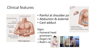 Clinical features
• Painful at shoulder joint
• Abduction & external rotation
• Cant adduct
Signs
o Humeral head
prominent
o Duga’s test
o Ruler’s sign
 