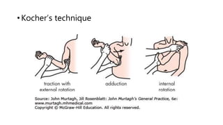 • Kocher’s technique
 
