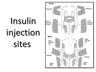 InsulinInsulin
injectioninjection
sitessites
 