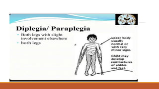 Diplegia/paraplegia
Both legs with slight involvement else where
Both legs
 