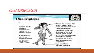 QUADRIPLEGIA
 