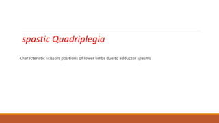 spastic Quadriplegia
Characteristic scissors positions of lower limbs due to adductor spasms
 