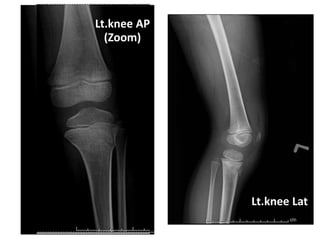 Lt.knee Lat
Lt.knee AP
(Zoom)
 