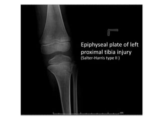 Epiphyseal plate of left
proximal tibia injury
(Salter-Harris type II )
 