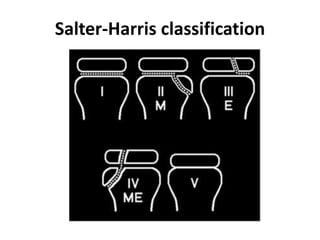 Salter-Harris classification
 