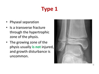 Type 1
• Physeal separation
• Is a transverse fracture
through the hypertrophic
zone of the physis.
• The growing zone of the
physis usually is not injured,
and growth disturbance is
uncommon.
 