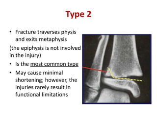 Type 2
• Fracture traverses physis
and exits metaphysis
(the epiphysis is not involved
in the injury)
• Is the most common type
• May cause minimal
shortening; however, the
injuries rarely result in
functional limitations
 