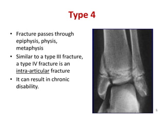 Type 4
• Fracture passes through
epiphysis, physis,
metaphysis
• Similar to a type III fracture,
a type IV fracture is an
intra-articular fracture
• It can result in chronic
disability.
 