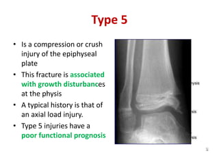 Type 5
• Is a compression or crush
injury of the epiphyseal
plate
• This fracture is associated
with growth disturbances
at the physis
• A typical history is that of
an axial load injury.
• Type 5 injuries have a
poor functional prognosis
 