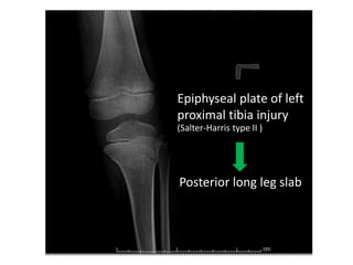 Epiphyseal plate of left
proximal tibia injury
(Salter-Harris type II )
Posterior long leg slab
 