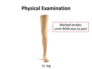 Physical Examination
Marked tender,
Limit ROM due to pain
Lt. leg
 