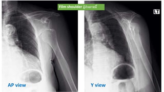 Y viewAP view
Film shoulder ผู้ป่วยรายนี้
 