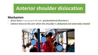 Anterior shoulder dislocation
Mechanism
- direct force จากแรงกระแทกทางด้านหลัง ( posterolateral direction )
- indirect force on the arm when the shoulder is abducted and externally rotated
 