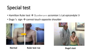 • Hamilton Ruler test  ไม้บรรทัดทาบจาก acromion ไป Lat epicondyle ได้
• Duga ‘s sign  cannot touch opposite shoulder
Special test
Normal Ruler test +ve Duga’s test
 