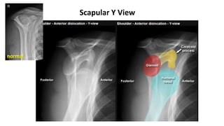 Scapular Y View
normal
 