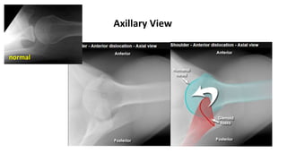 Axillary View
normal
 