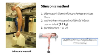 Stimson’s method
Stimson’s method
1. ให้ผู้ป่วยนอนคว่า ให้แขนข้างที่ได้รับบาดเจ็บห้อยลงมาตามแรง
โน้มถ่วง
2. ถ่วงน้าหนักด้วยการห้อยแขวนน้าหนักไว้ที่ข้อมือ ใช้น้าหนัก
ประมาณ 5 ปอนด์ (2.2 kg)
3. รอนานประมาณ 15 – 20 นาที
เป็นวิธีที่ทาให้เกิดการบาดเจ็บของเนื้อเยื่อโดยรอบ
จากการดึงน้อยที่สุด
 