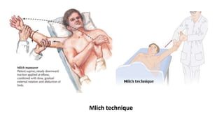 Mlich technique
 