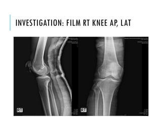 Pfd Rt Knee Conference ortho patella fx | PDF