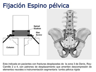 Fijación Espino pélvica
Esta indicada en pacientes con fracturas desplazadas de la zona 3 de Denis, Roy-
Camille 2 a 4, con patrones de desplazamiento que ameriten descompresión de
elementos neurales e instrumentación segmentaria lumbo pélvica rígida
 
