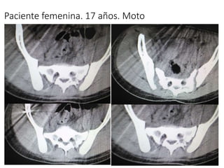 Paciente femenina. 17 años. Moto
 